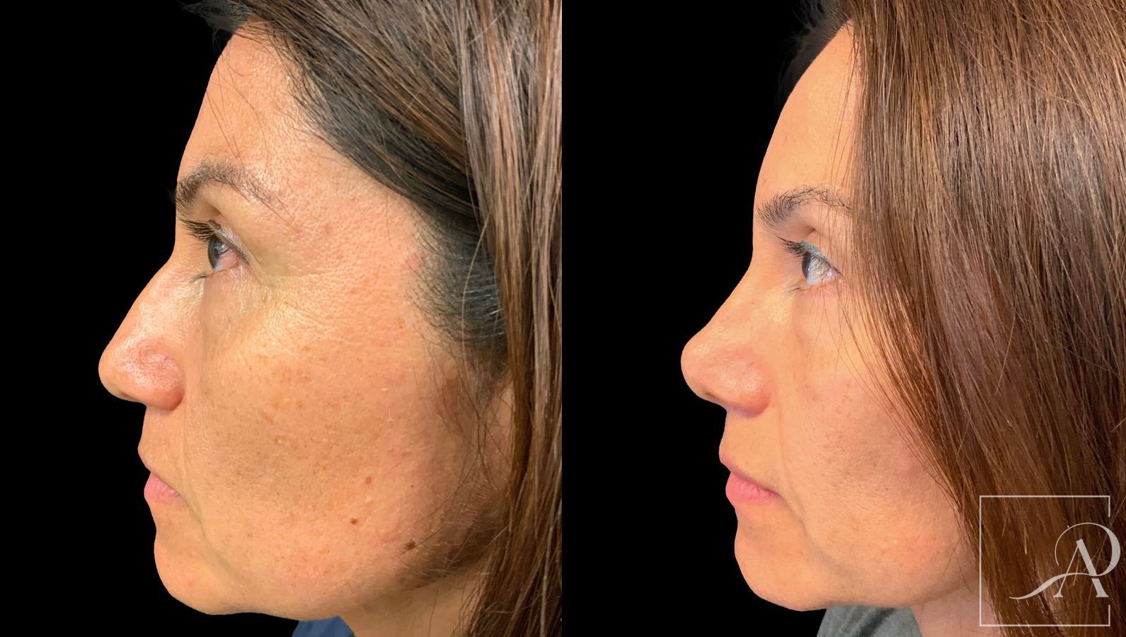 Before and after Rhinoplasty case 43390