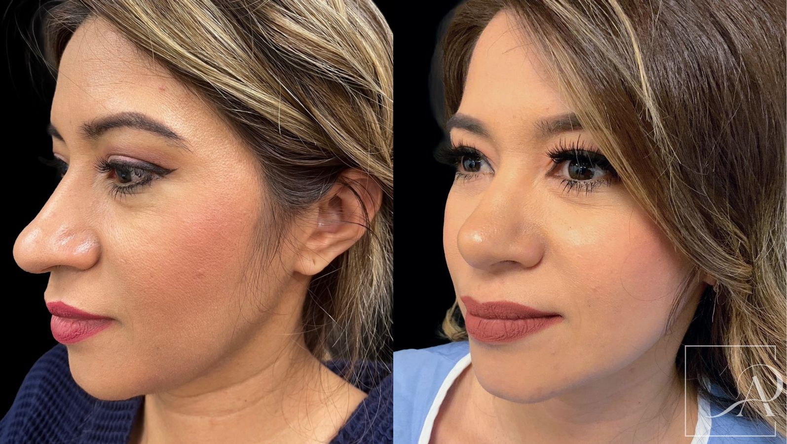 Before and after Rhinoplasty case 43389 - Angle 2