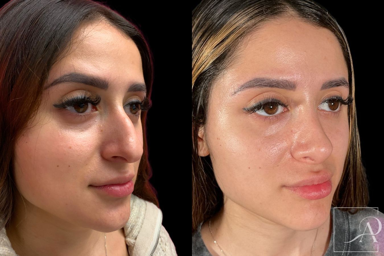 Before and after Rhinoplasty case 46338 - Angle 4