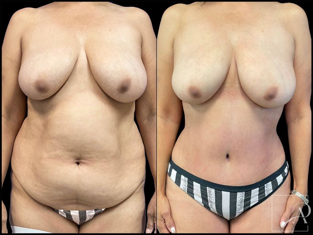 Before and after 360 Liposuction case 43393 - Angle 3