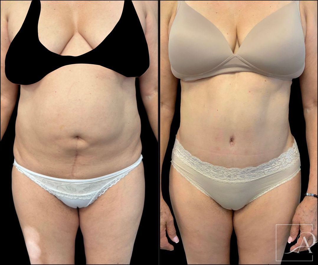 Before and after Tummy Tuck case 43395 - Angle 2