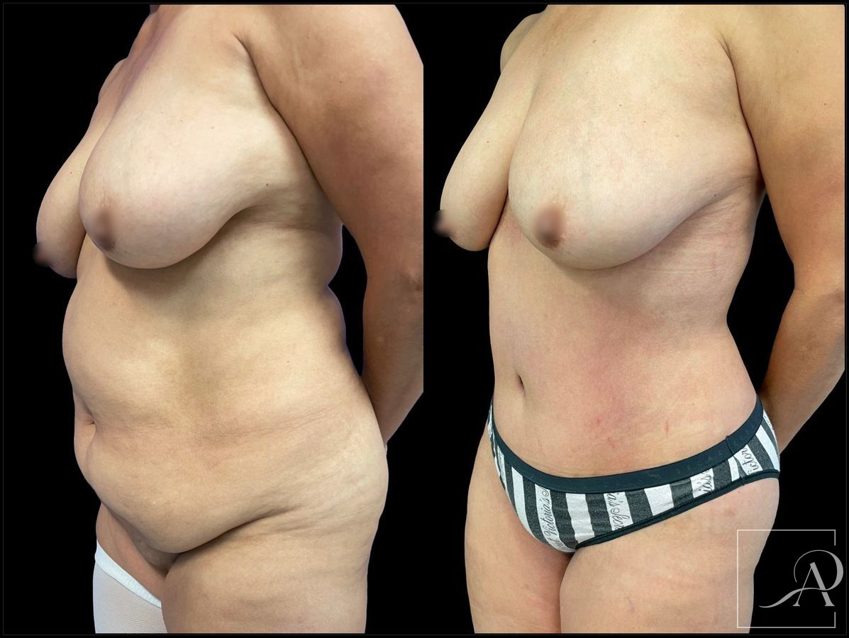 Before and after 360 Liposuction case 43393 - Angle 2