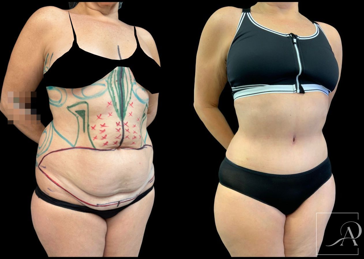 Before and after Liposuction case 49492 - Angle 4