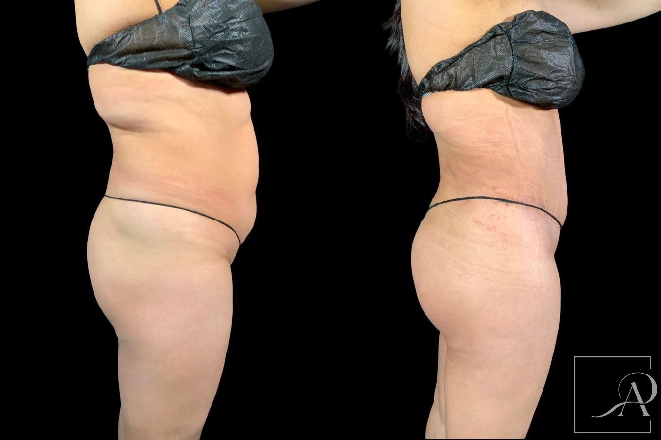 Before and after Tummy Tuck case 43346 - Angle 5