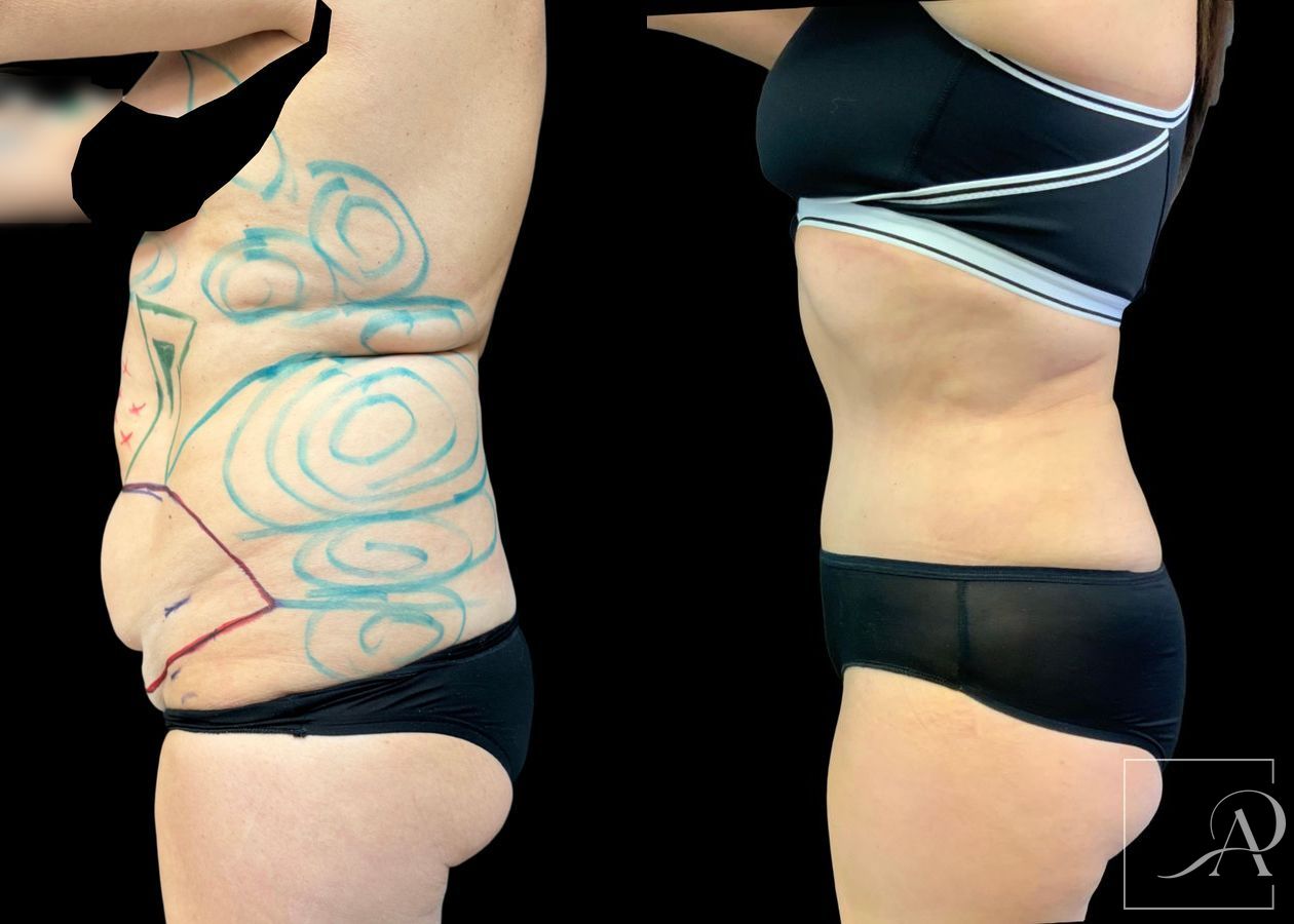 Before and after Liposuction case 49492 - Angle 3