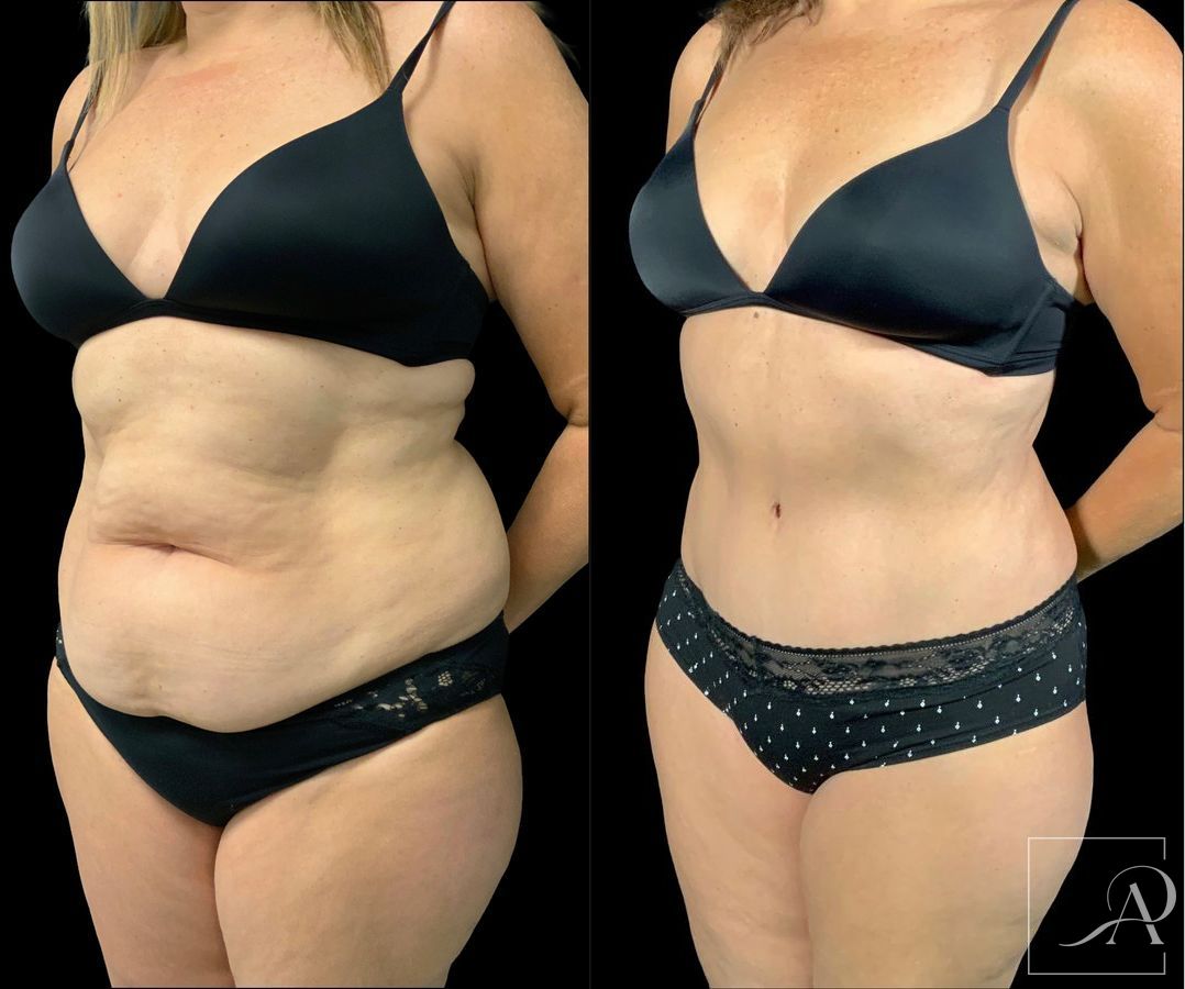 Before and after Tummy Tuck case 43391 - Angle 2