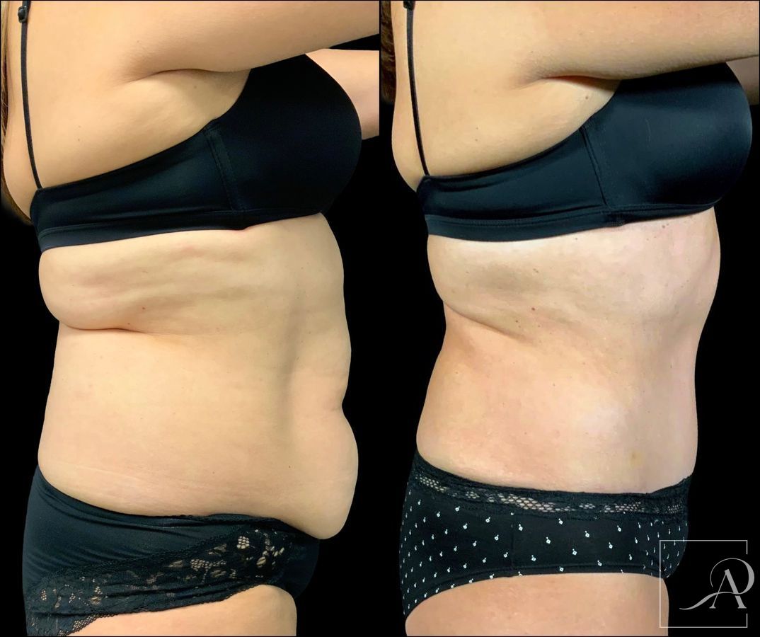 Before and after Tummy Tuck case 43391 - Angle 5