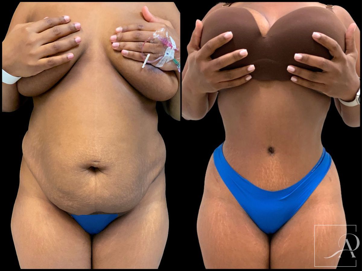 Before and after Tummy Tuck case 43394 - Angle 3