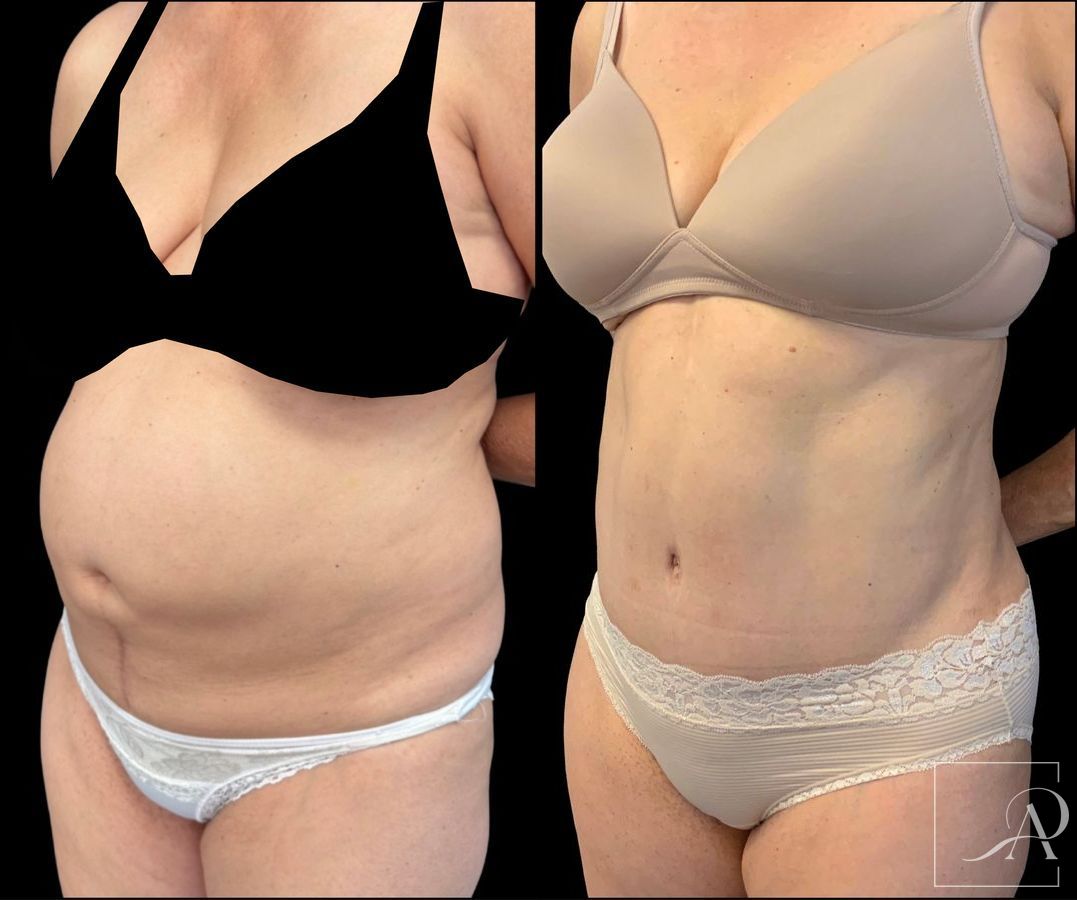 Before and after Tummy Tuck case 43395