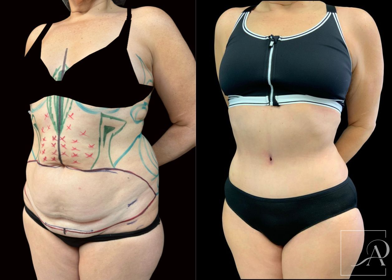 Before and after Liposuction case 49492 - Angle 2