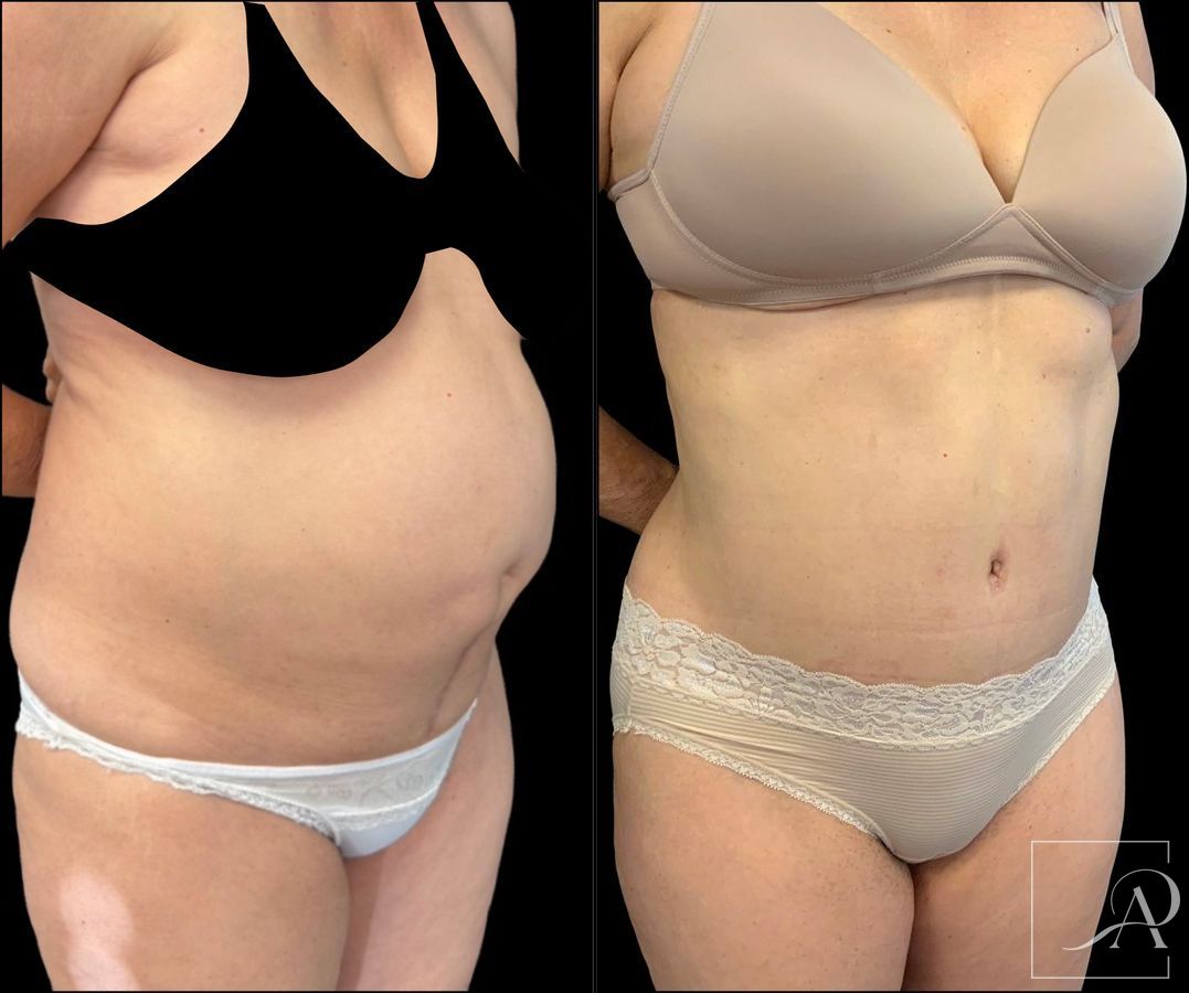 Before and after Tummy Tuck case 43395 - Angle 3