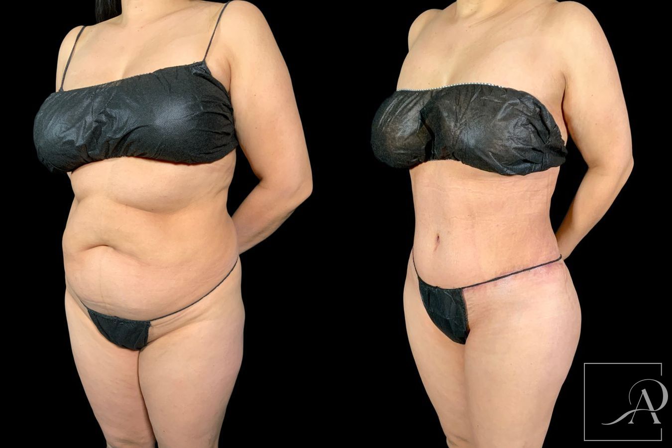 Before and after Tummy Tuck case 43346 - Angle 2
