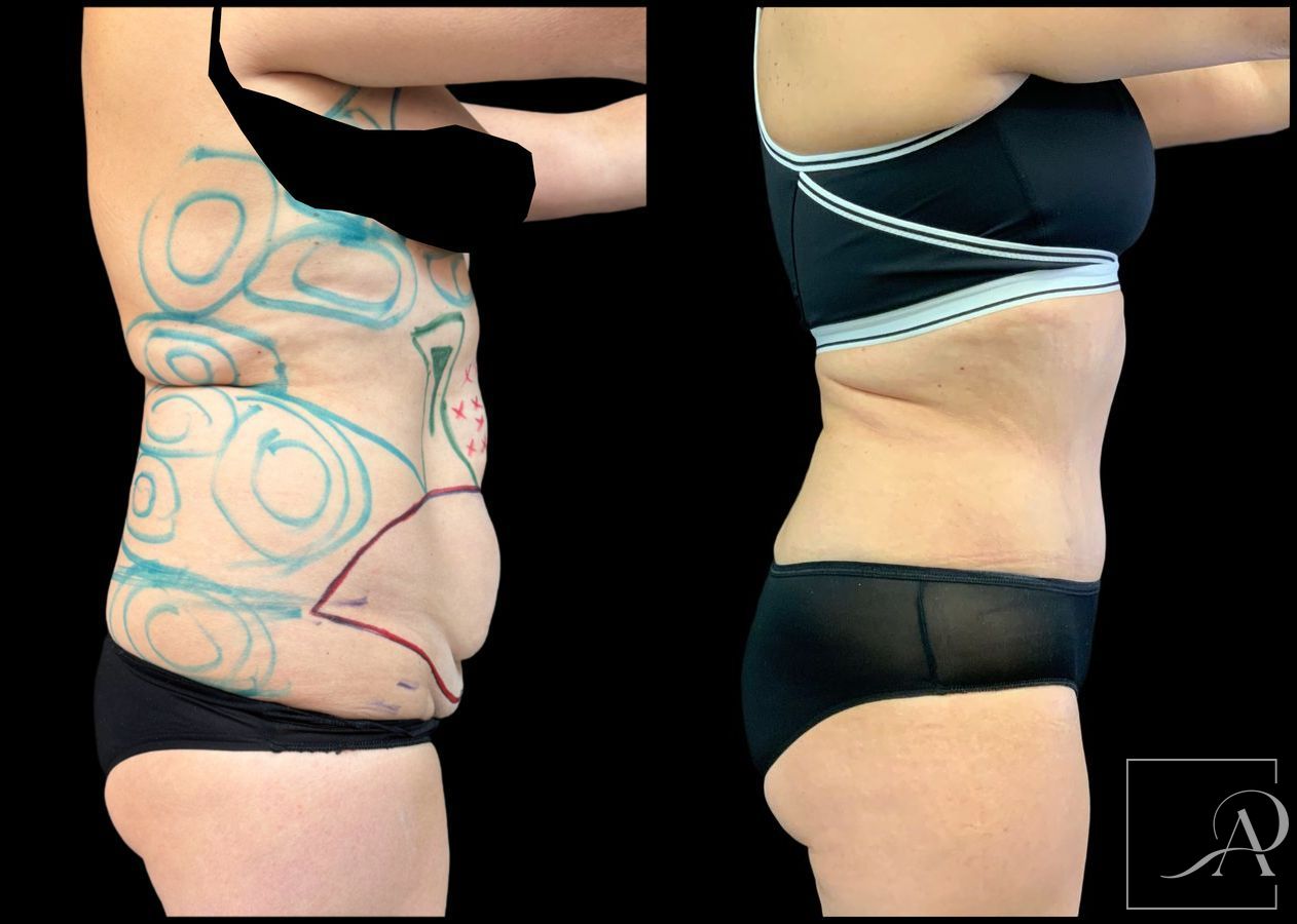 Before and after Liposuction case 49492 - Angle 5