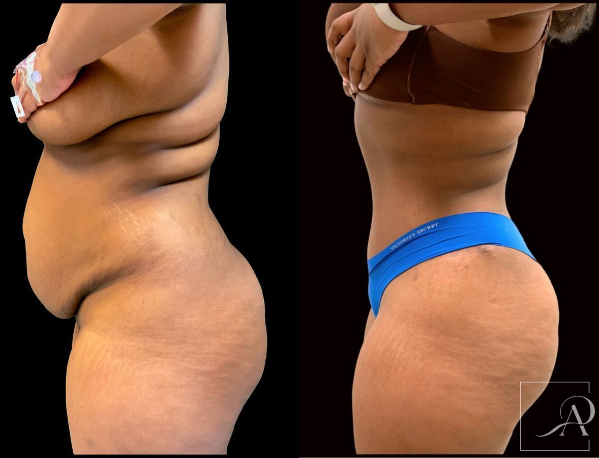 Before and after Tummy Tuck case 43394