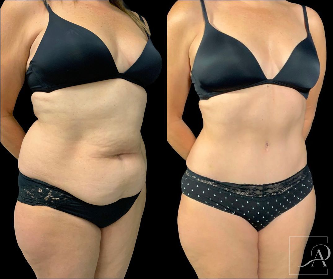 Before and after Tummy Tuck case 43391 - Angle 4
