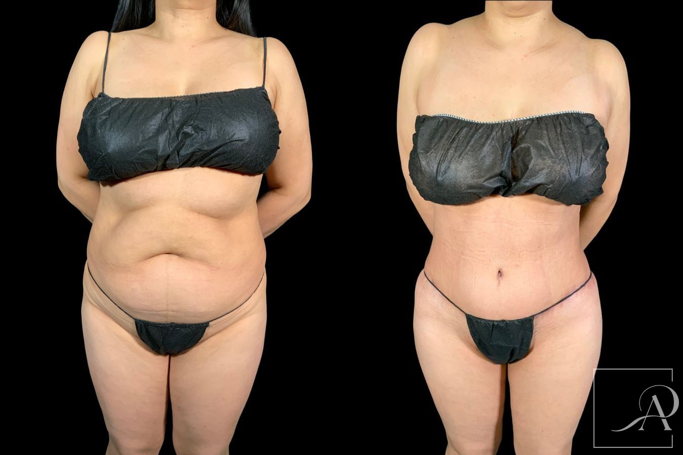 Before and after Tummy Tuck case 43346 - Angle 3