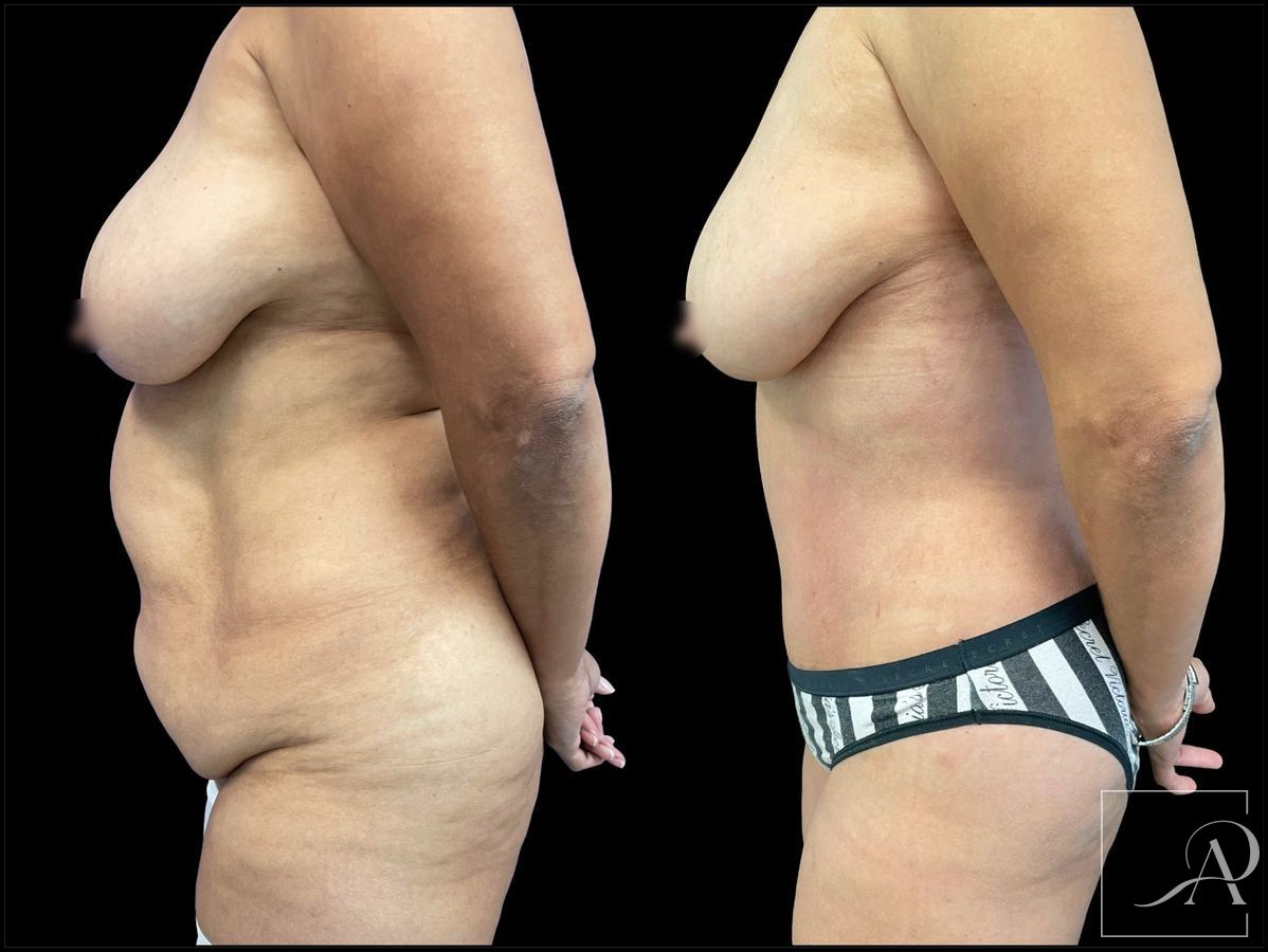 Before and after 360 Liposuction case 43393