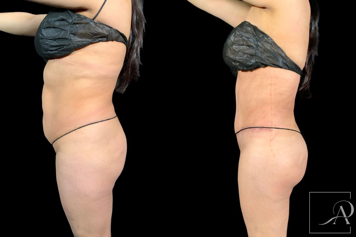 Before and after Tummy Tuck case 43346