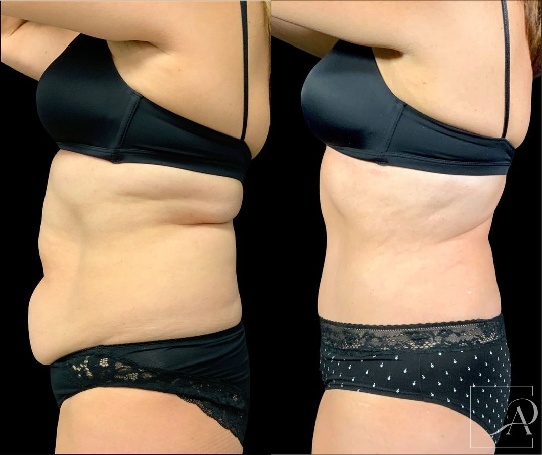 Before and after Tummy Tuck case 43391