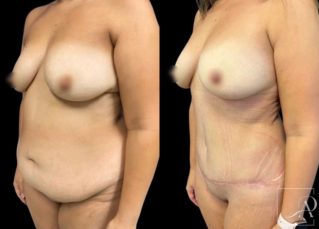 Before and after Liposuction case 46761 - Angle 2