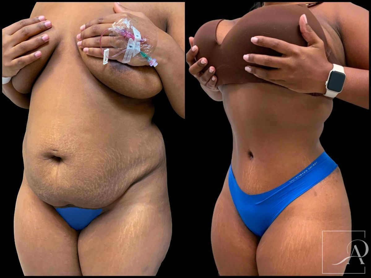 Before and after Tummy Tuck case 43394 - Angle 2