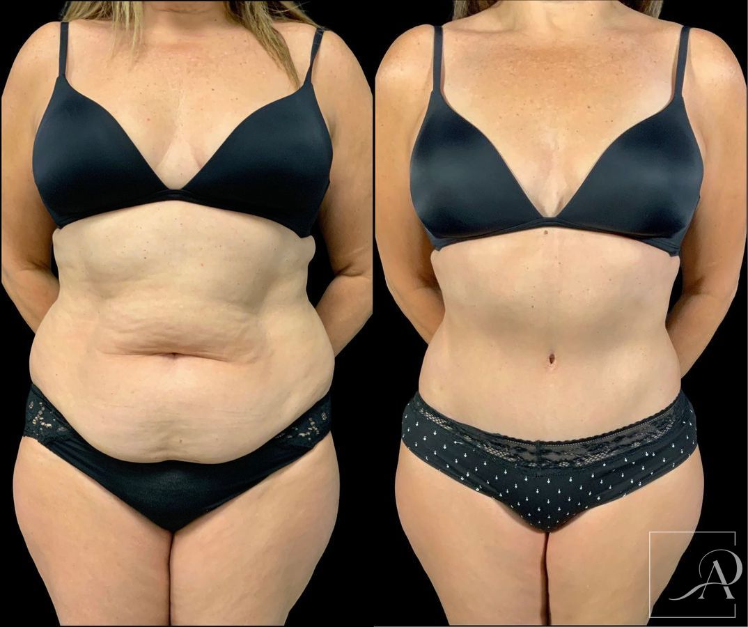 Before and after Tummy Tuck case 43391 - Angle 3