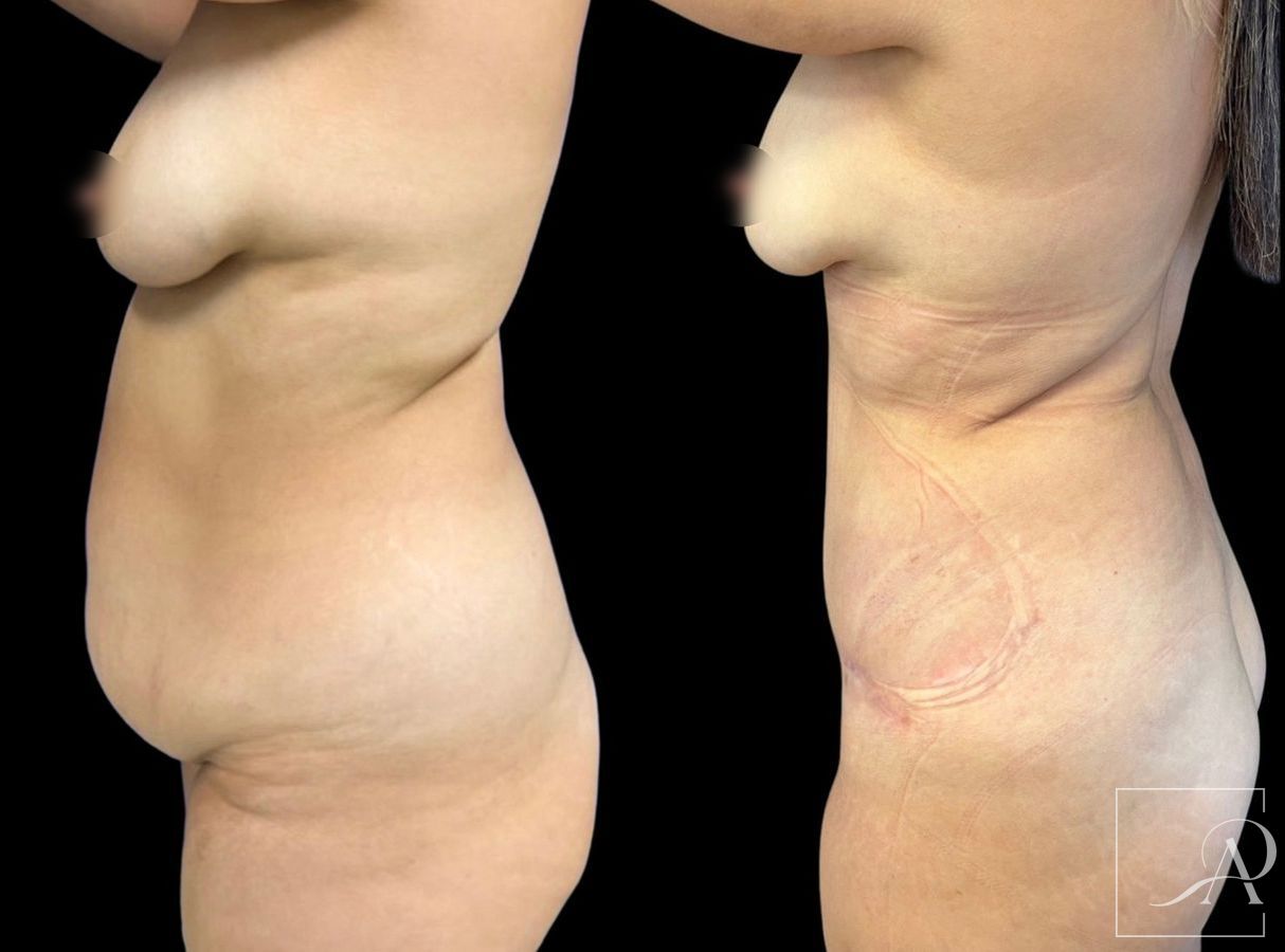 Before and after Liposuction case 46761 - Angle 3