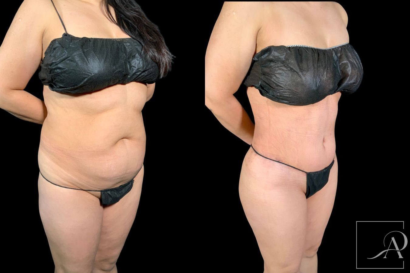 Before and after Tummy Tuck case 43346 - Angle 4
