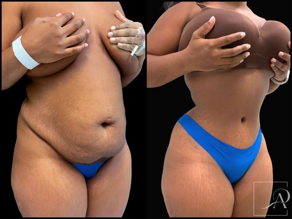 Before and after Tummy Tuck case 43394 - Angle 4