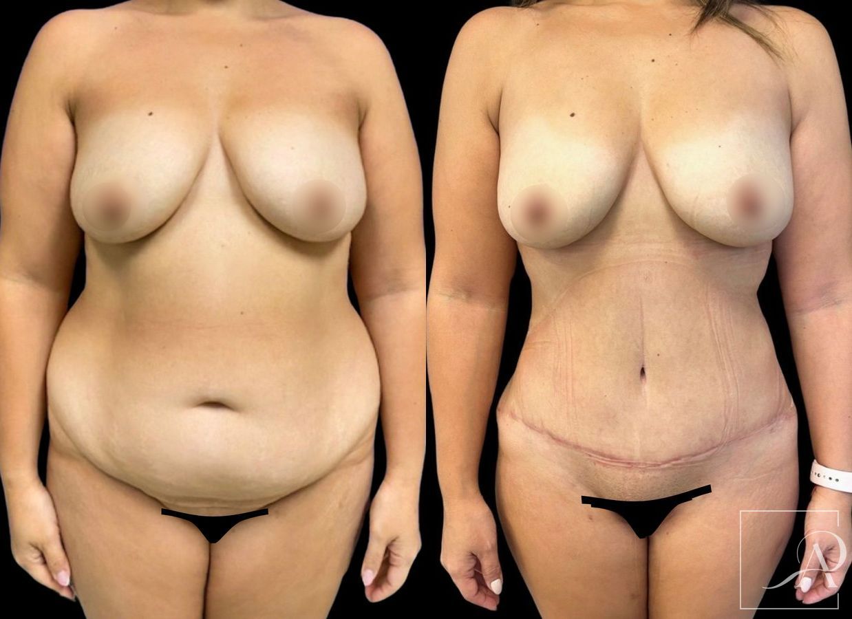 Before and after Liposuction case 46761