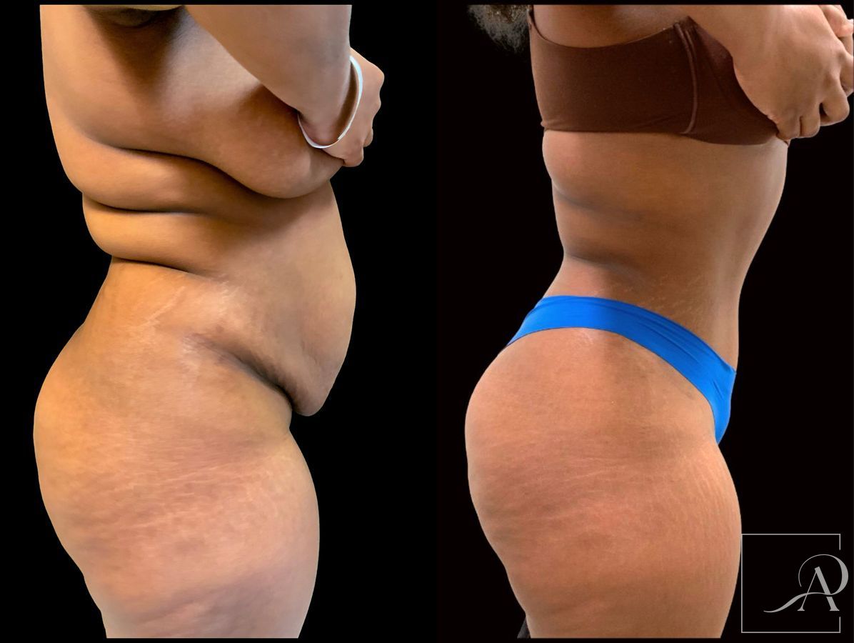 Before and after Tummy Tuck case 43394 - Angle 5