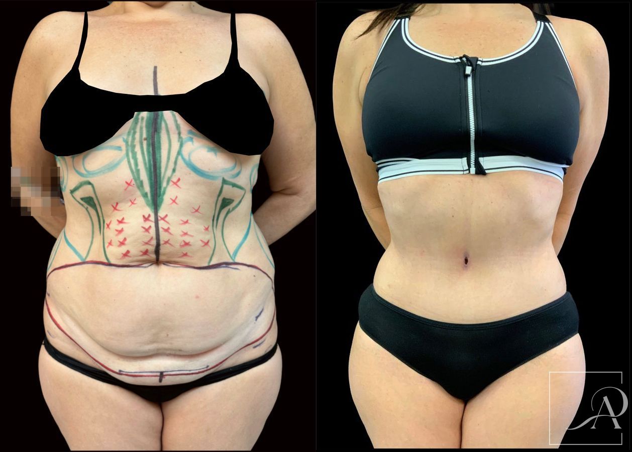 Before and after Liposuction case 49492