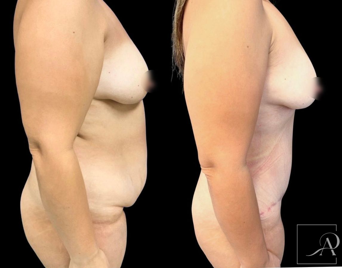 Before and after Liposuction case 46761 - Angle 4