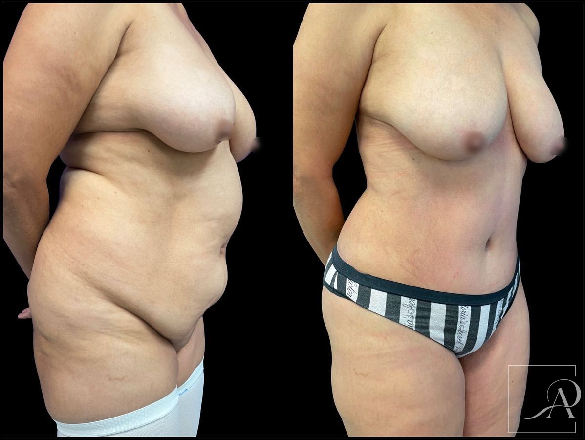 Before and after 360 Liposuction case 43393 - Angle 4