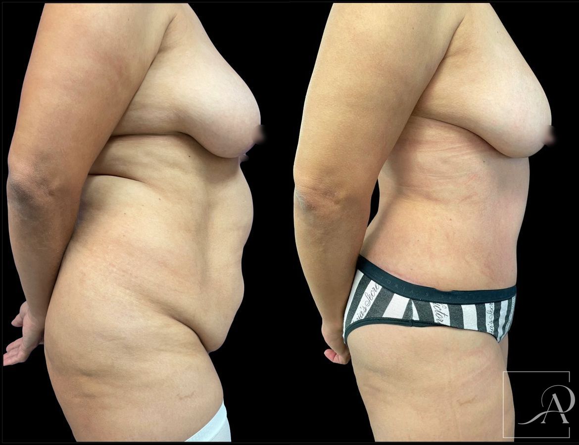 Before and after 360 Liposuction case 43393 - Angle 5
