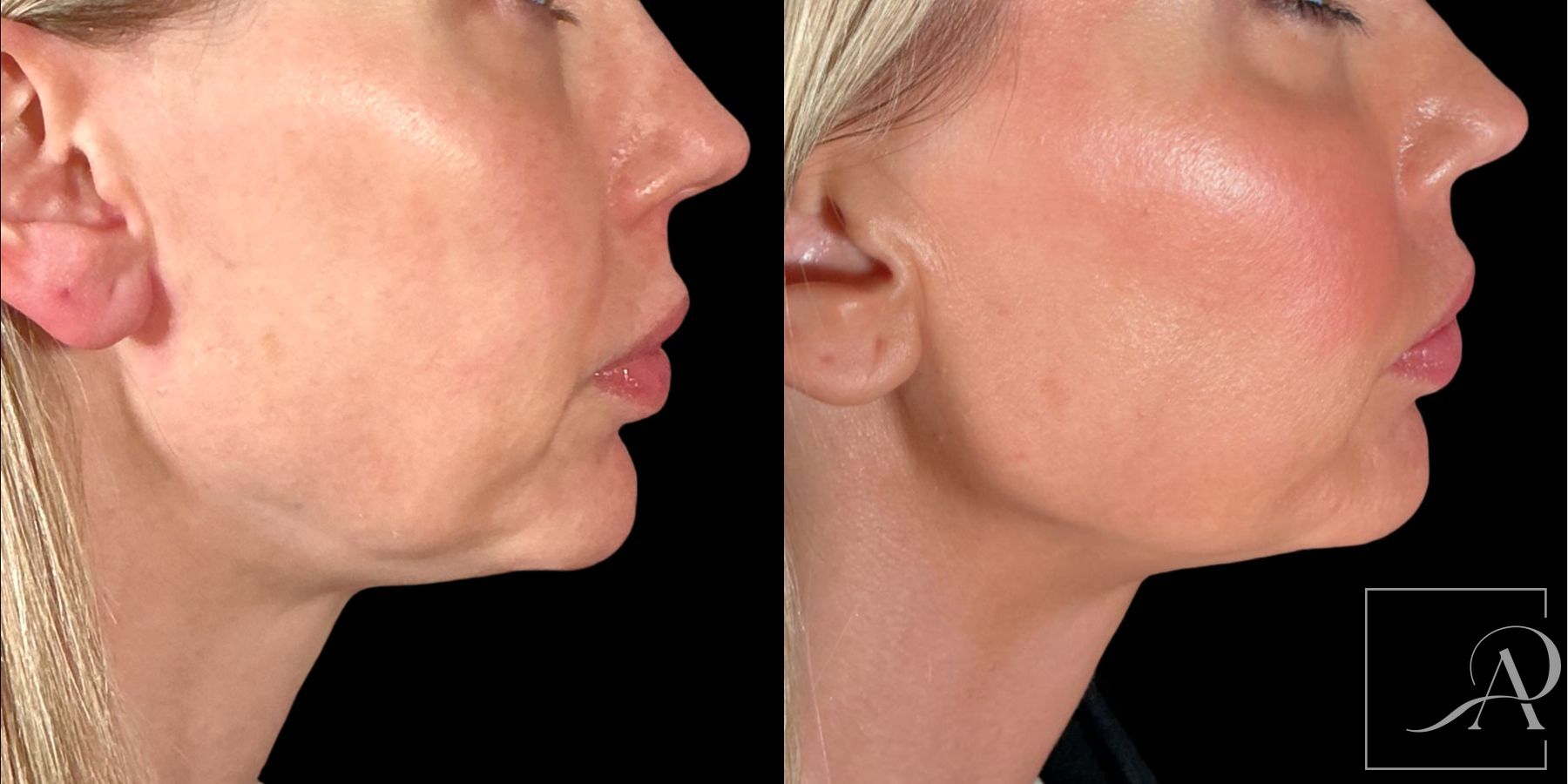 Before and after Ultherapy Prime case 49500
