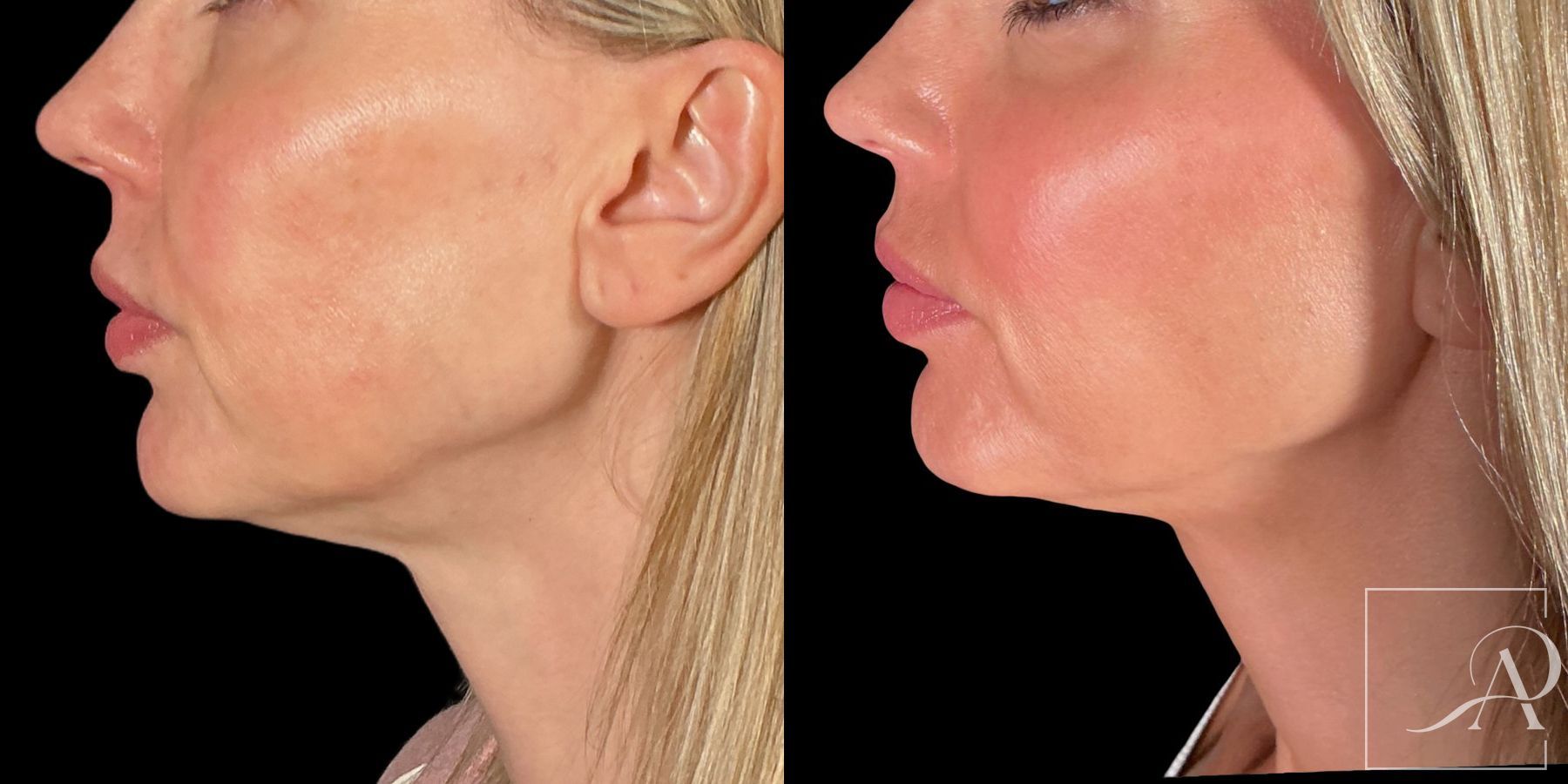 Before and after Ultherapy Prime case 49500 - Angle 2