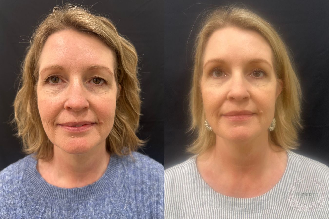 Before and after Blepharoplasty case 46133