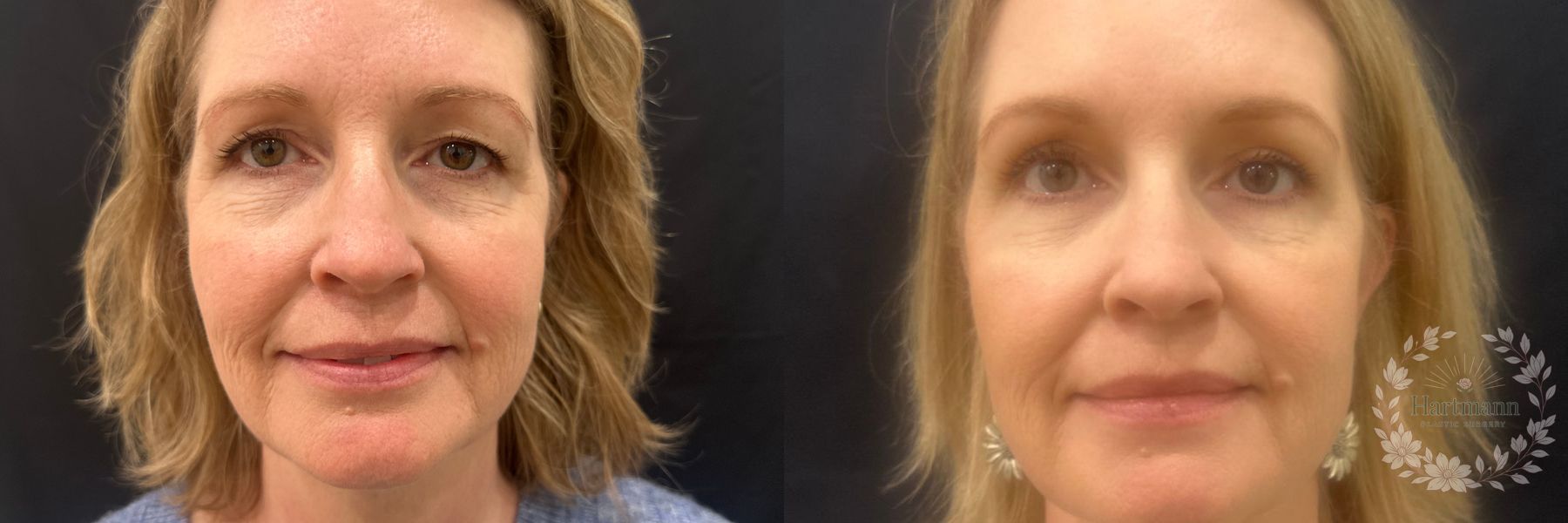 Before and after upper eyelid blepharoplasty showing reduction of excess upper eyelid skin and a naturally refreshed eye appearance by Dr. Emily Hartmann.