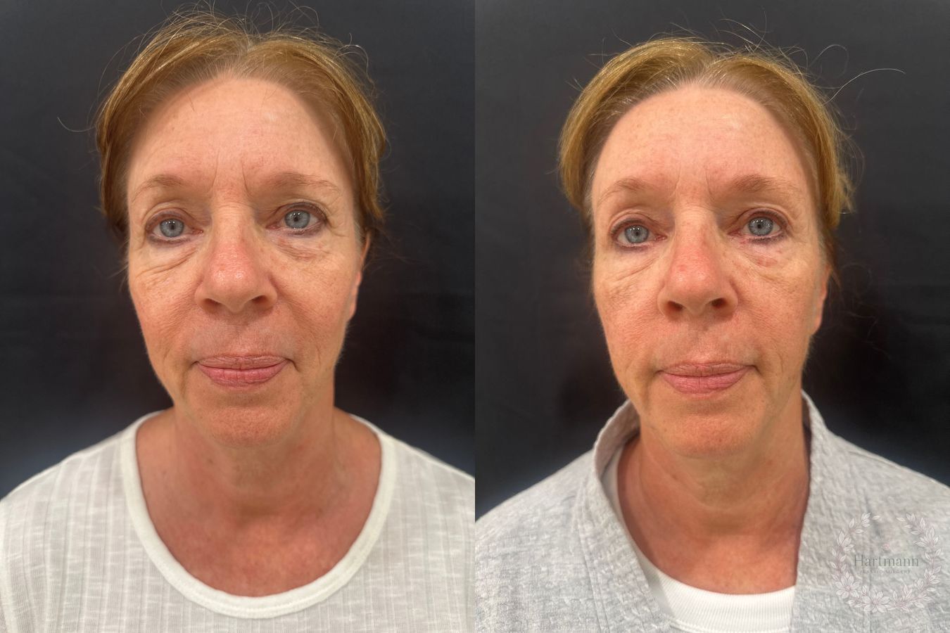 Before and after upper and lower blepharoplasty performed by Dr. Emily Hartmann in Chico, California, showing natural eyelid rejuvenation and a refreshed appearance.