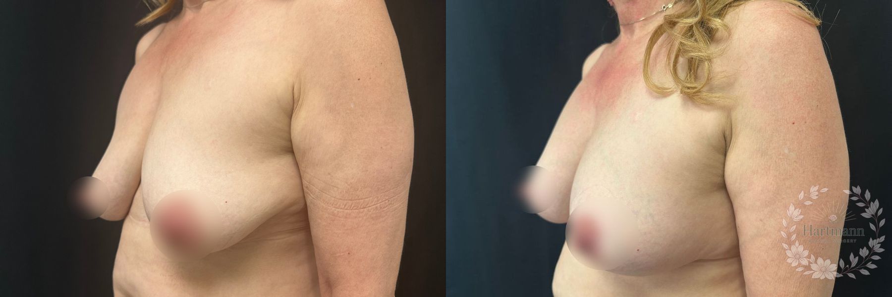 Before and after Breast Augmentation case 45841 - Angle 2