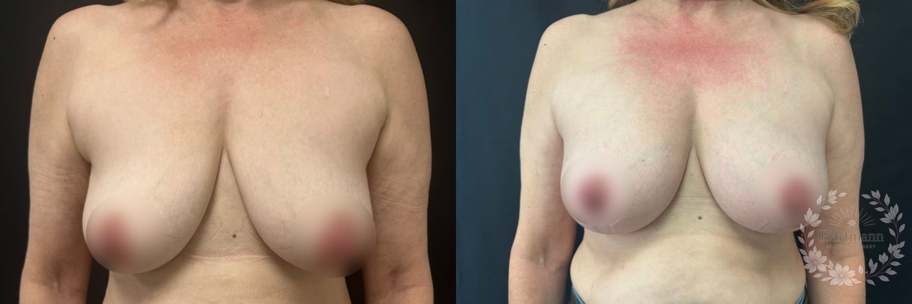 Before and after Breast Augmentation case 45841