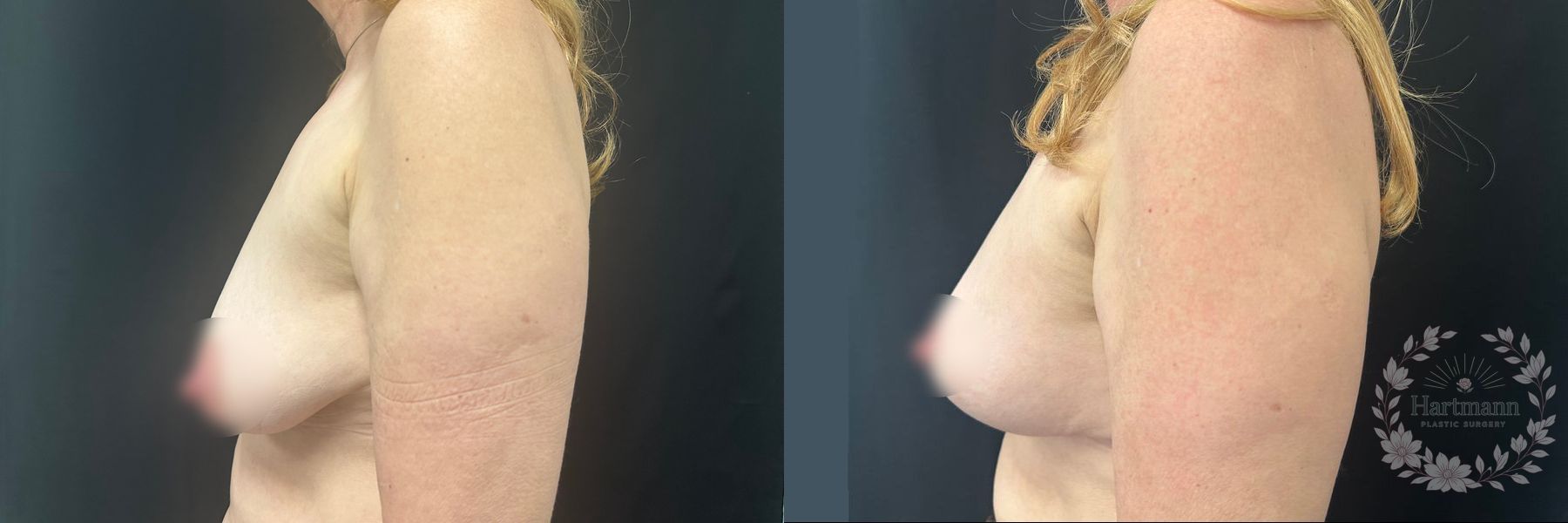 Before and after Breast Augmentation case 45841 - Angle 3