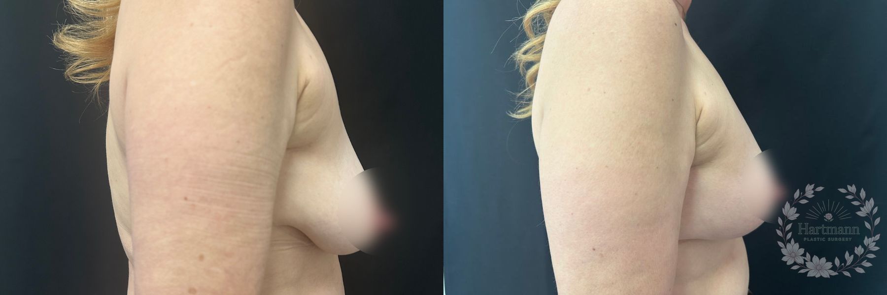 Before and after Breast Augmentation case 45841 - Angle 4