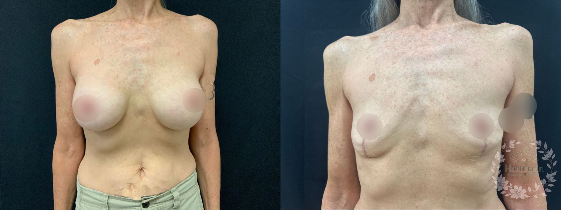 Before and after breast implant removal with breast lift performed by Dr. Emily Hartmann in Chico, California, restoring natural breast shape and position.