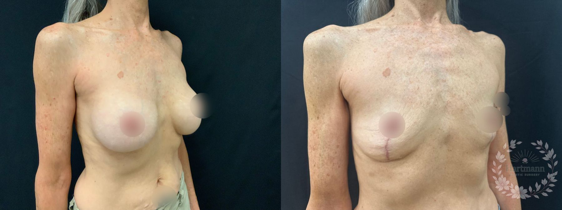 Before and after breast implant removal with breast lift performed by Dr. Emily Hartmann in Chico, California, restoring natural breast shape and position. - Angle 2