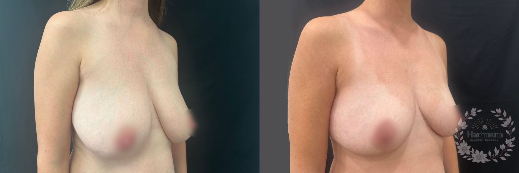 Before and after Breast Reduction case 45847 - Angle 3