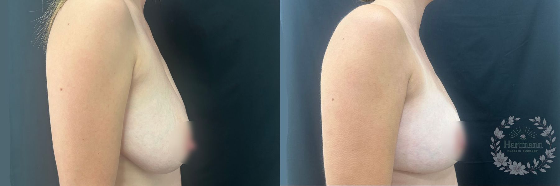 Before and after Breast Reduction case 45847 - Angle 4