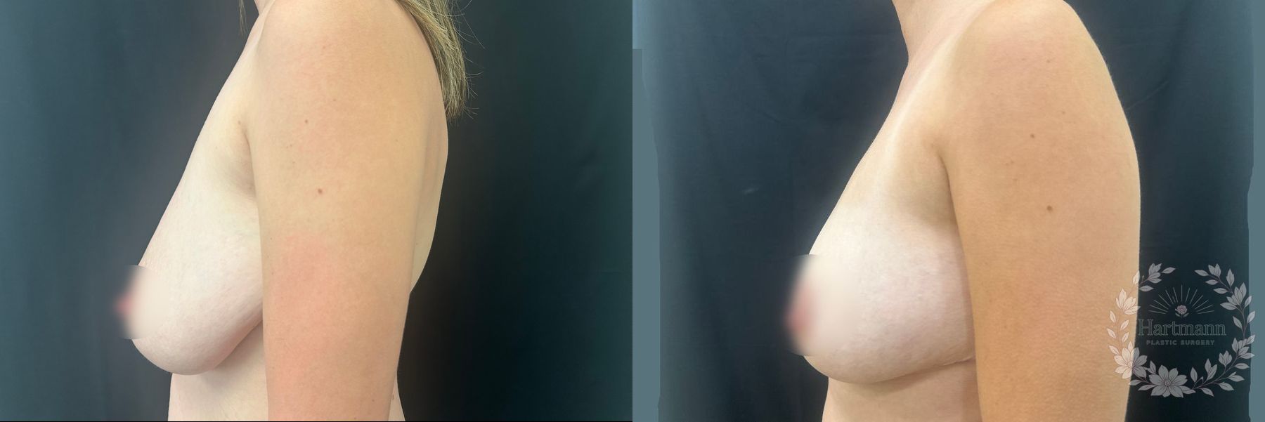 Before and after Breast Reduction case 45847 - Angle 5