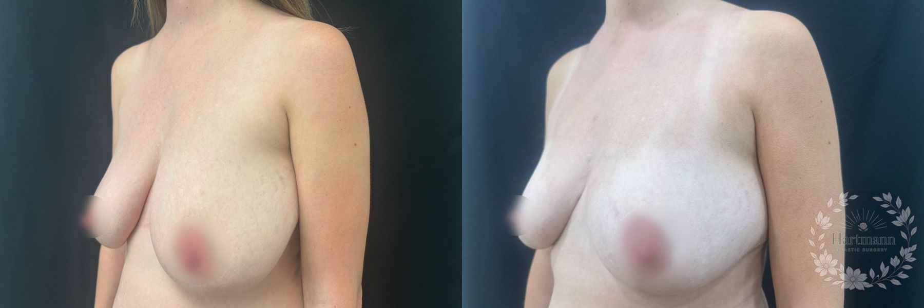 Before and after Breast Reduction case 45847 - Angle 2